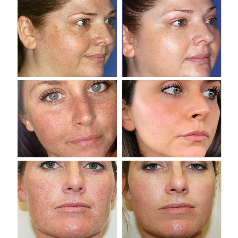 Wybielający krem ​​do piegów U – Skincare Glowing recenzja i cena